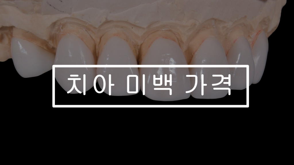 치아-미백-가격