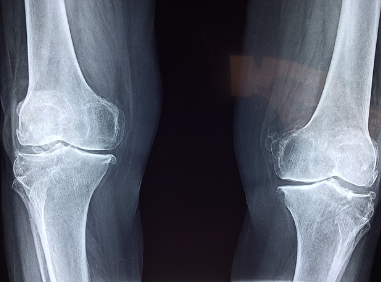 무릎 통증의 진단과 치료